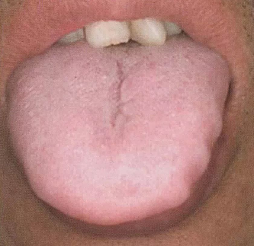艾学习舌诊│舌形质