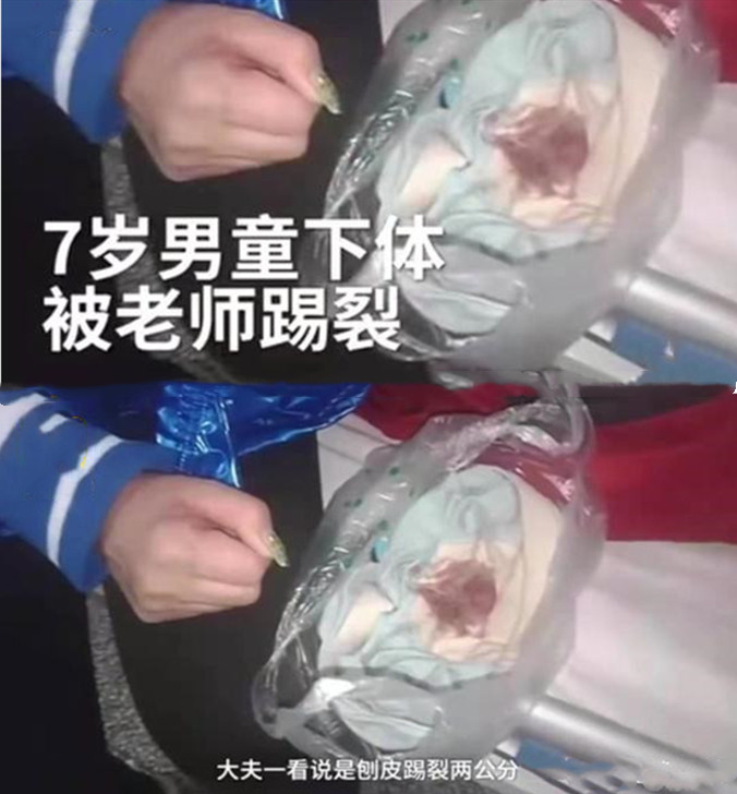 原创女老师一记撩阴腿七岁男孩下体被踢裂家长特气愤