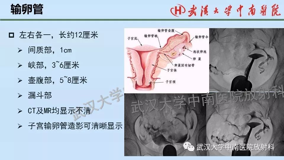 女性生殖系統影像解剖及子宮常見疾病