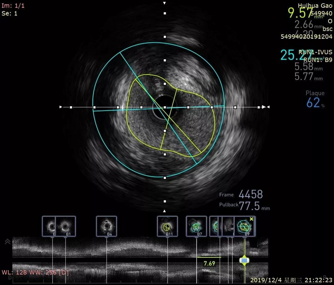 透视冠状动脉的"第三只眼"——金山区首例冠状动脉血管内超声(ivus)在