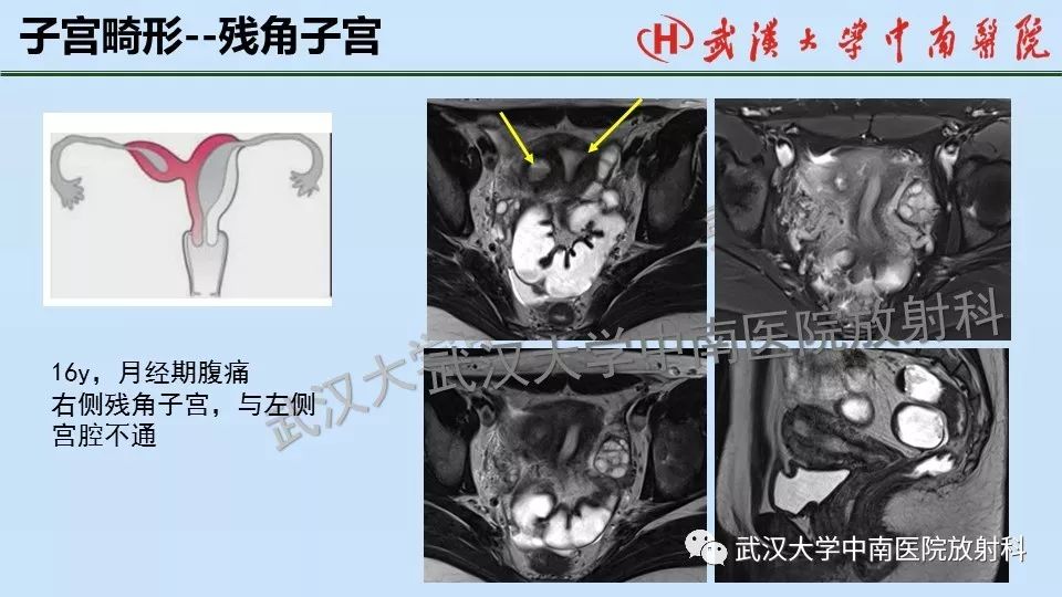 女性生殖系統影像解剖及子宮常見疾病