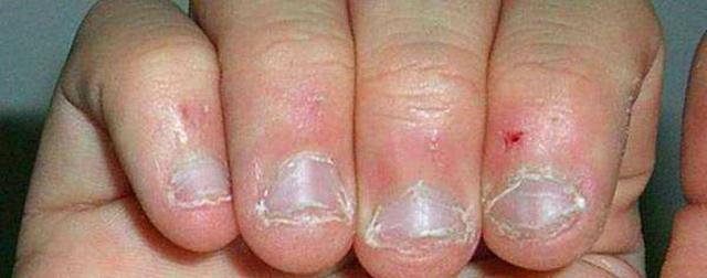 喜欢"咬指甲"的小朋友,长大后是什么状态?多年后让父母心疼