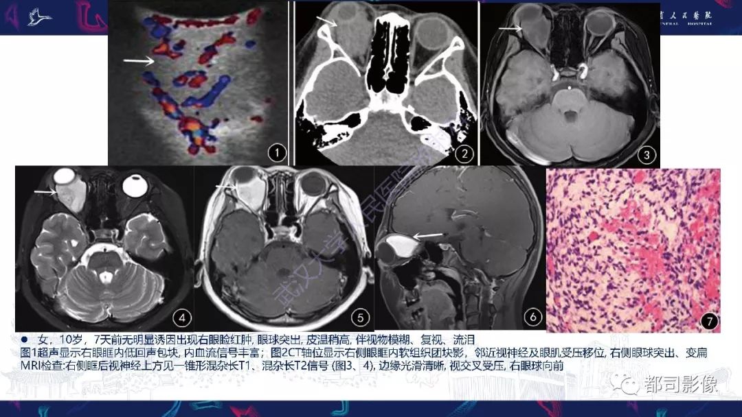 关于眼眶胚胎性横纹肌肉瘤影像诊断