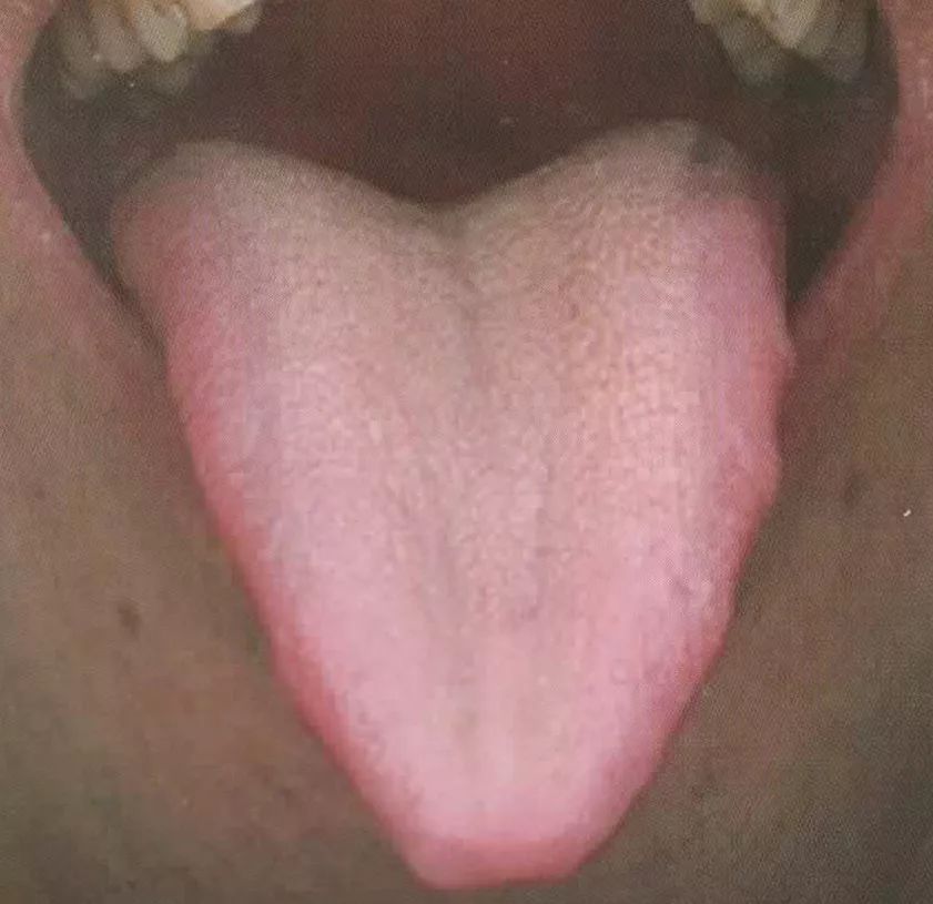 艾学习舌诊│舌形质