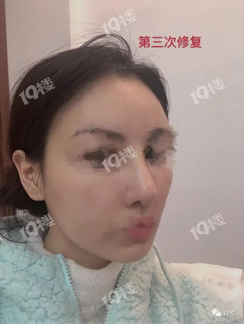 杭州姑娘鼻整形失败,三次修复也无济于事"我的人生都灰暗了…网友