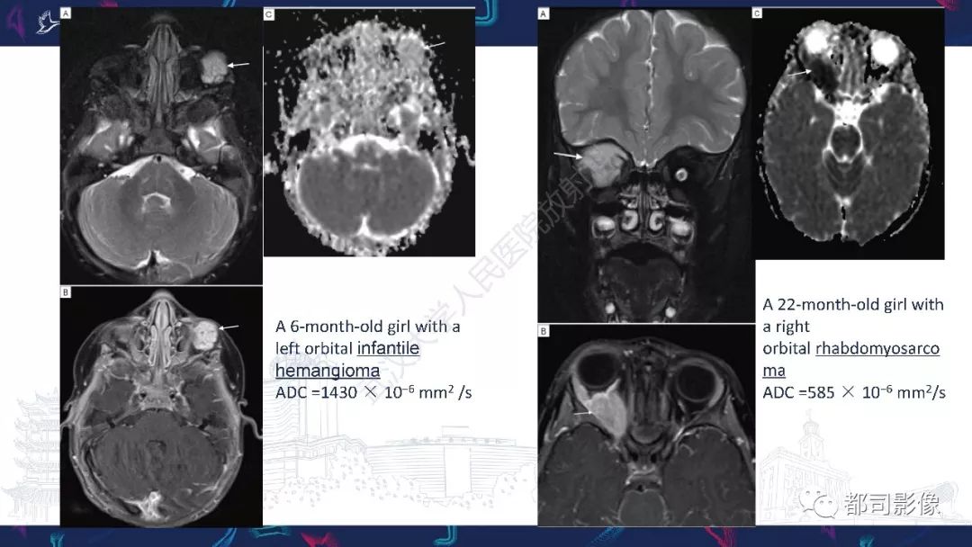 关于眼眶胚胎性横纹肌肉瘤影像诊断