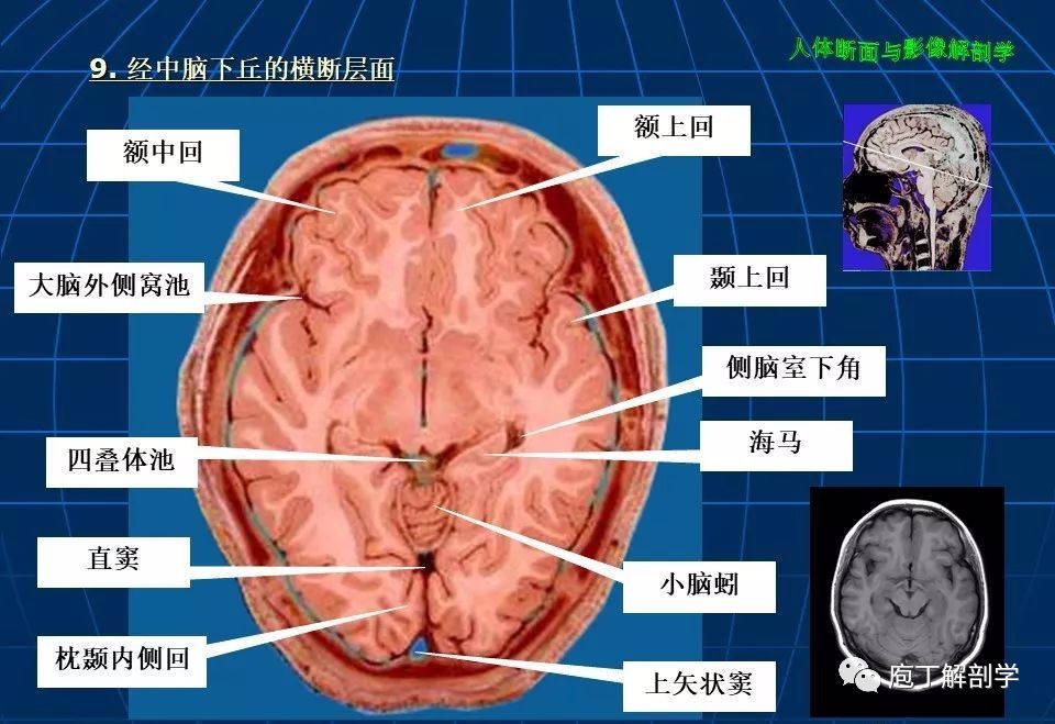 经颅窝池对照表图片