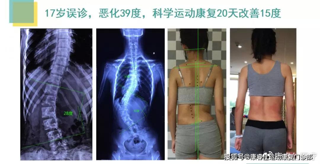 深圳康睿仕德国施罗斯脊柱侧弯矫形三维矫正训练课程介绍-搜狐大视野-搜狐新闻