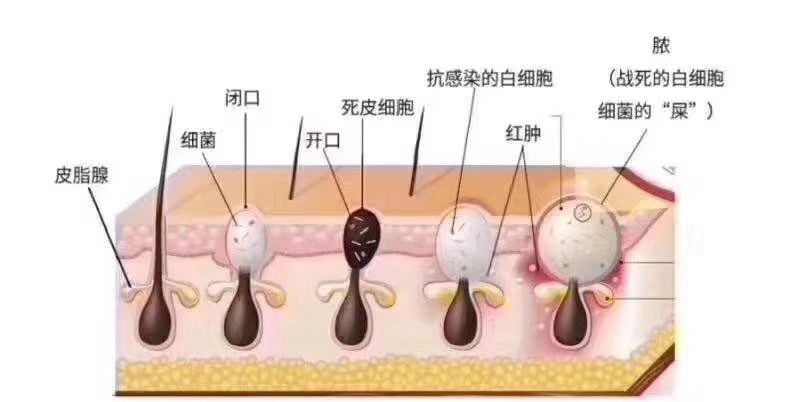 黑头粉刺型,多发于t区,堵在毛孔里面的油脂栓 c.