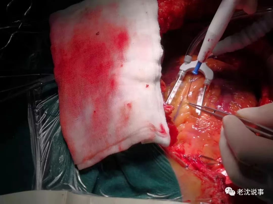 第9手术室冠心病杂交手术图