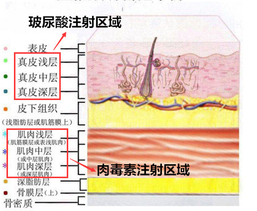 口周纹肉毒素注射方法图片