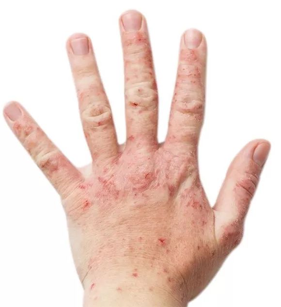 常见过敏原包括肥皂