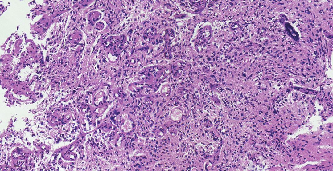 1,术中冰冻病理报的是高级别胶质瘤.