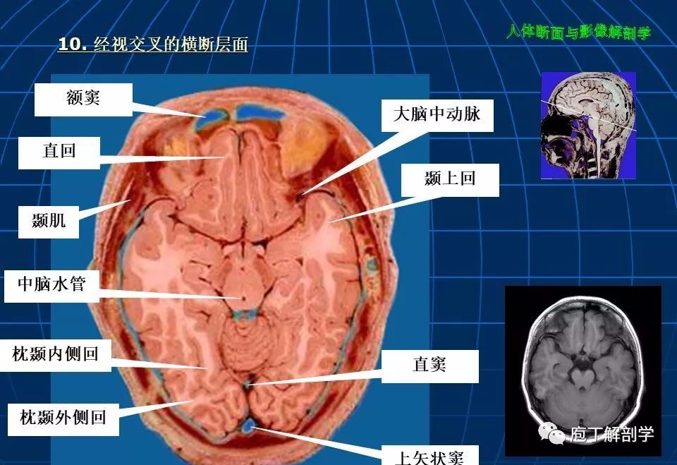 颅脑大体断层解剖(轴位)