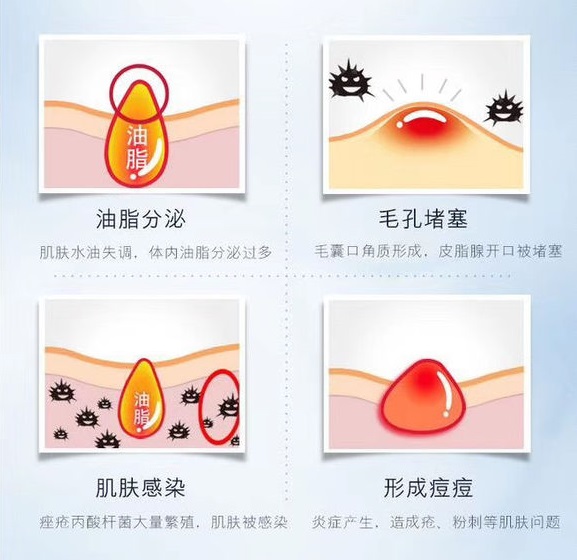 当皮脂腺分泌过多油脂,无法脱离毛囊口,就形成了粉刺,粉刺感染了痤疮