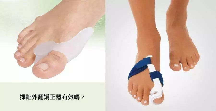拇趾外翻怎么办?_脚趾