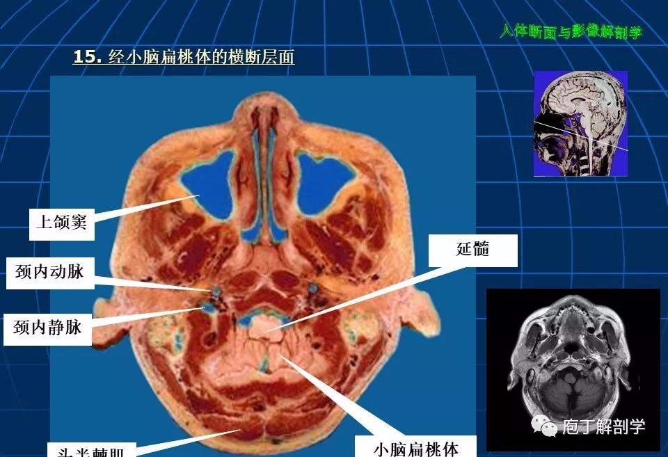 顱腦大體斷層解剖(軸位)