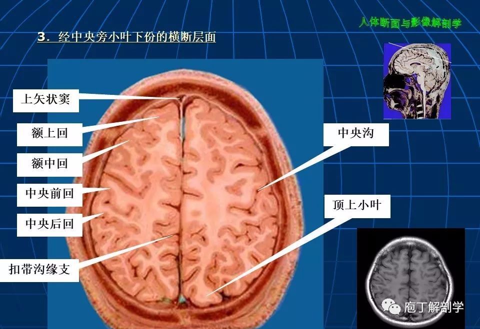 颅脑大体断层解剖(轴位)