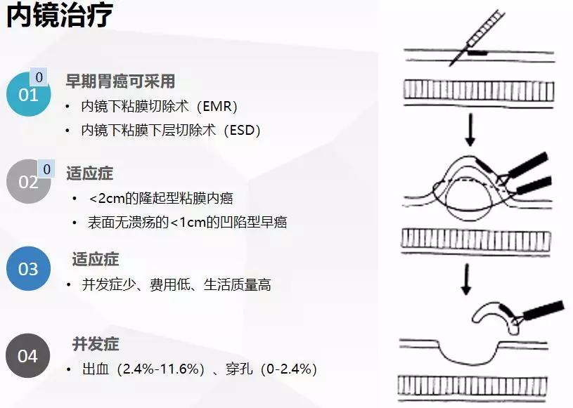 伦琴医疗核心专家张欢教授关于胃癌你一定要了解的知识