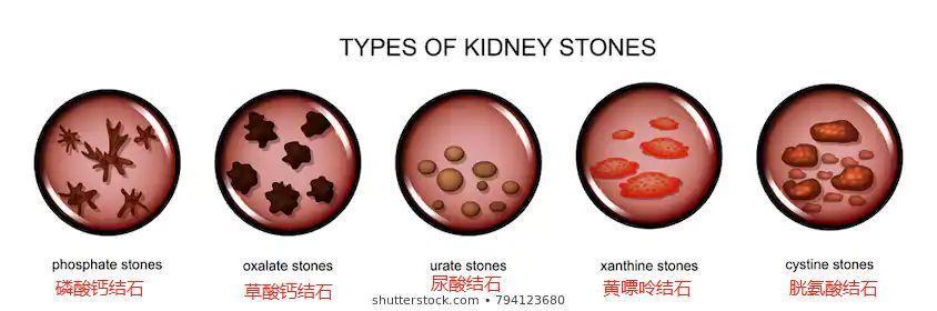 20多岁的小伙双肾长满结石只因为每天都喝这些水