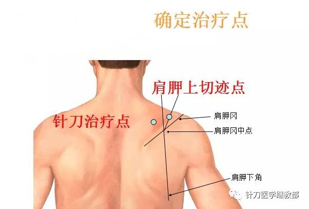 针刀治疗肩痛必治点—肩胛上切迹_神经
