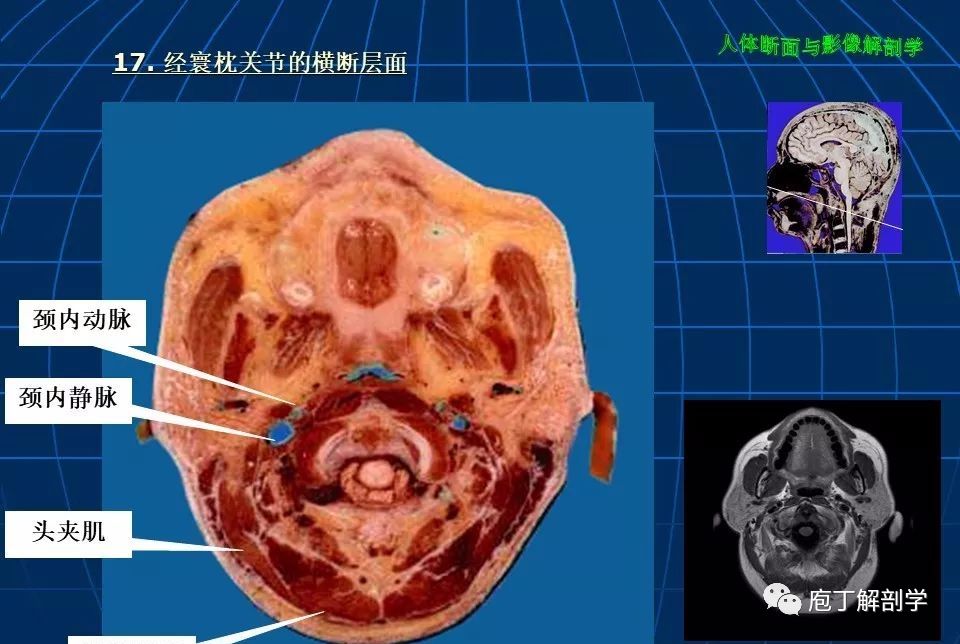 枕骨断层解剖图片