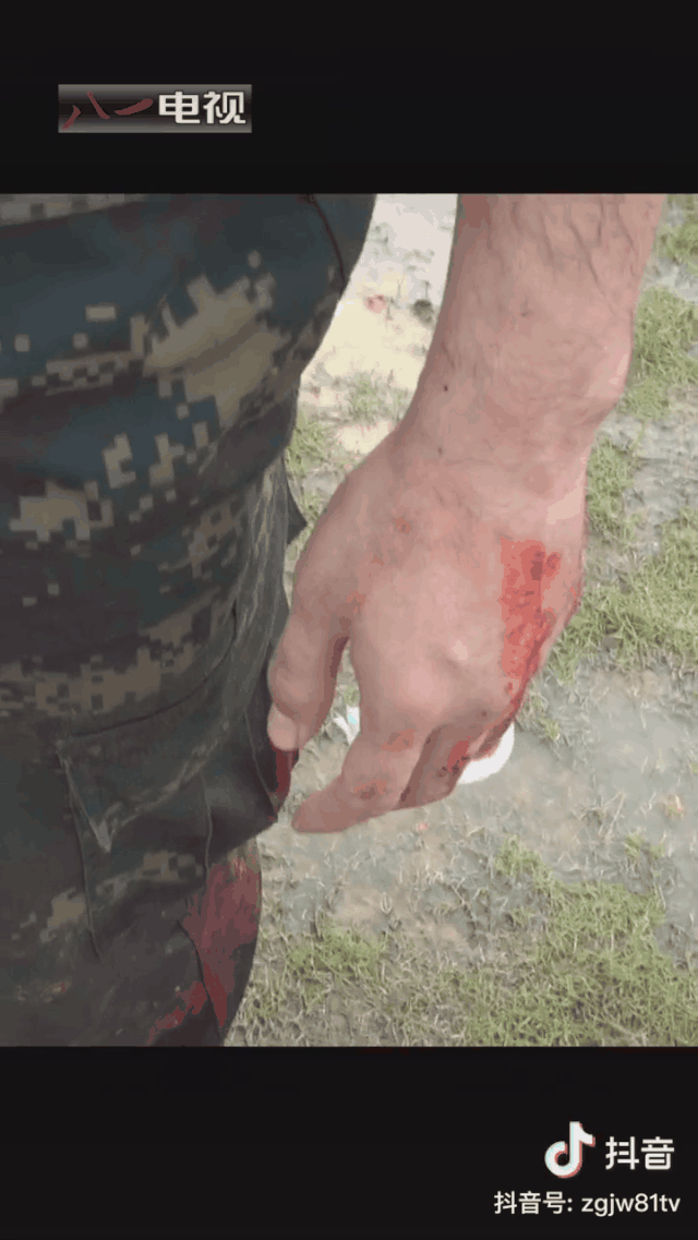 军人胳膊受伤图片图片