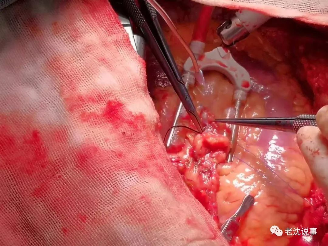 第9手术室冠心病杂交手术图