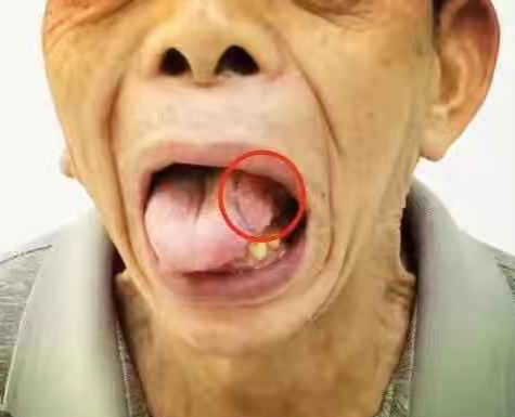 迅速增大的肿块,无特殊症状的多个牙齿松动,下唇麻木,不明原因的面瘫