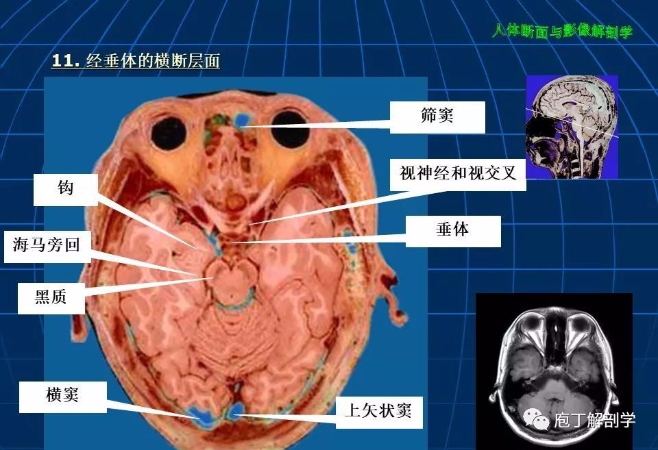 颅脑大体断层解剖(轴位)