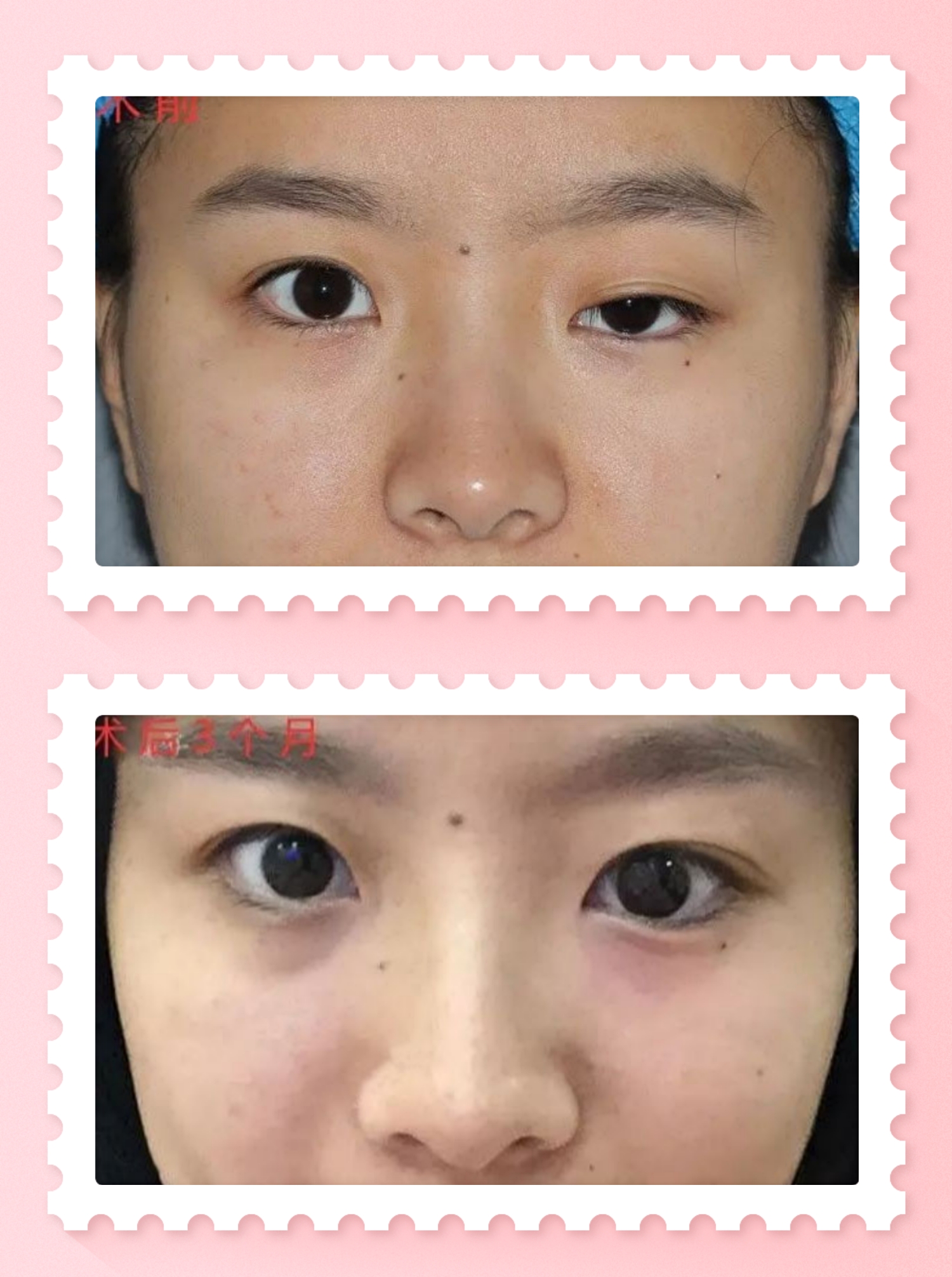 【余文林】上睑下垂自测及治疗方式_眼睑