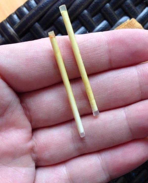 2,长期有效:优于避孕套和避孕药的短期和持续使用,埋线之后,一般可以