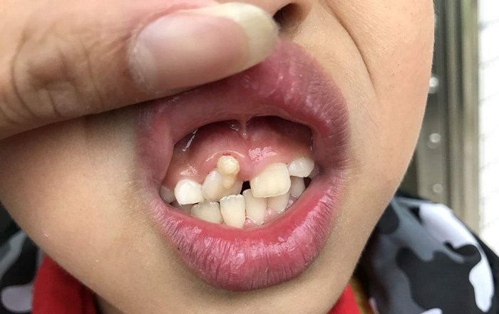 原创为啥孩子乳牙换成恒牙,就不整齐了?大多是父母没做好这4件事