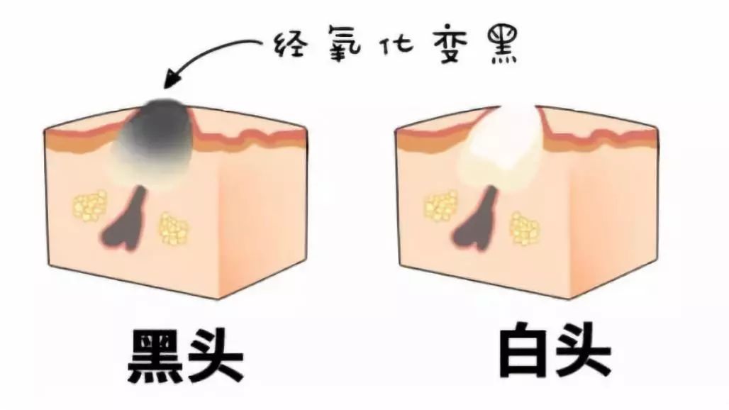 为什么你会长黑头,黑头危害大,学会预防是关键