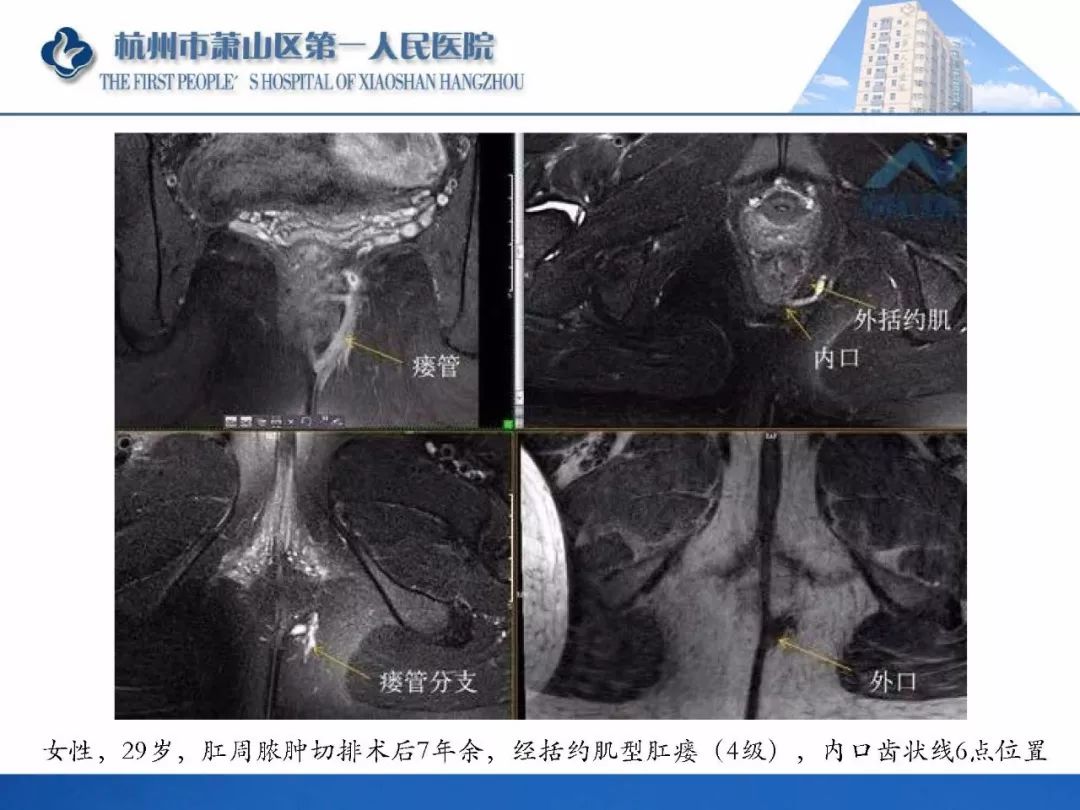 肛提肌mri图片