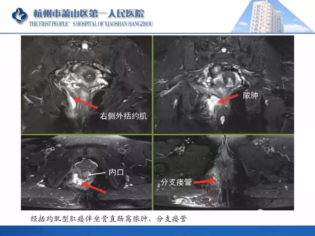 肛提肌mri图片