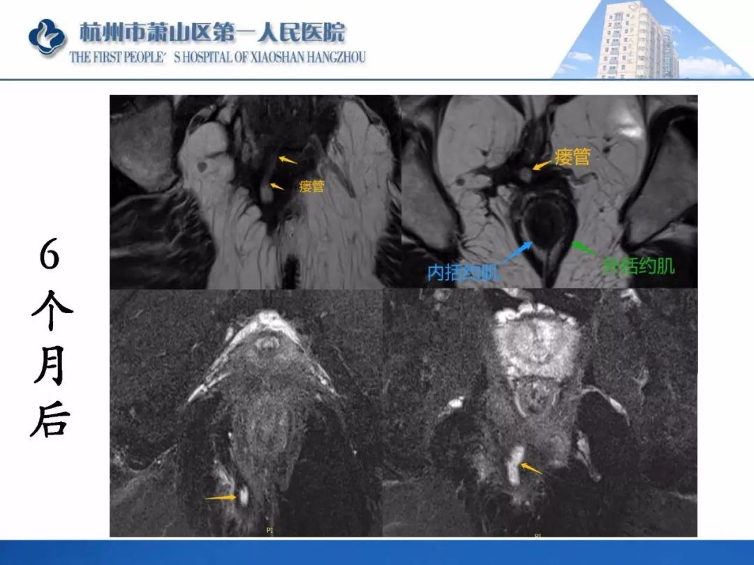清晰版肛瘘的mri诊断