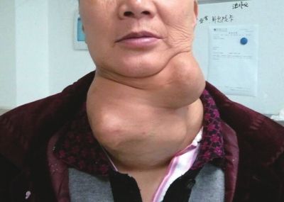 甲状腺癌4个早期的症状发现别忽视