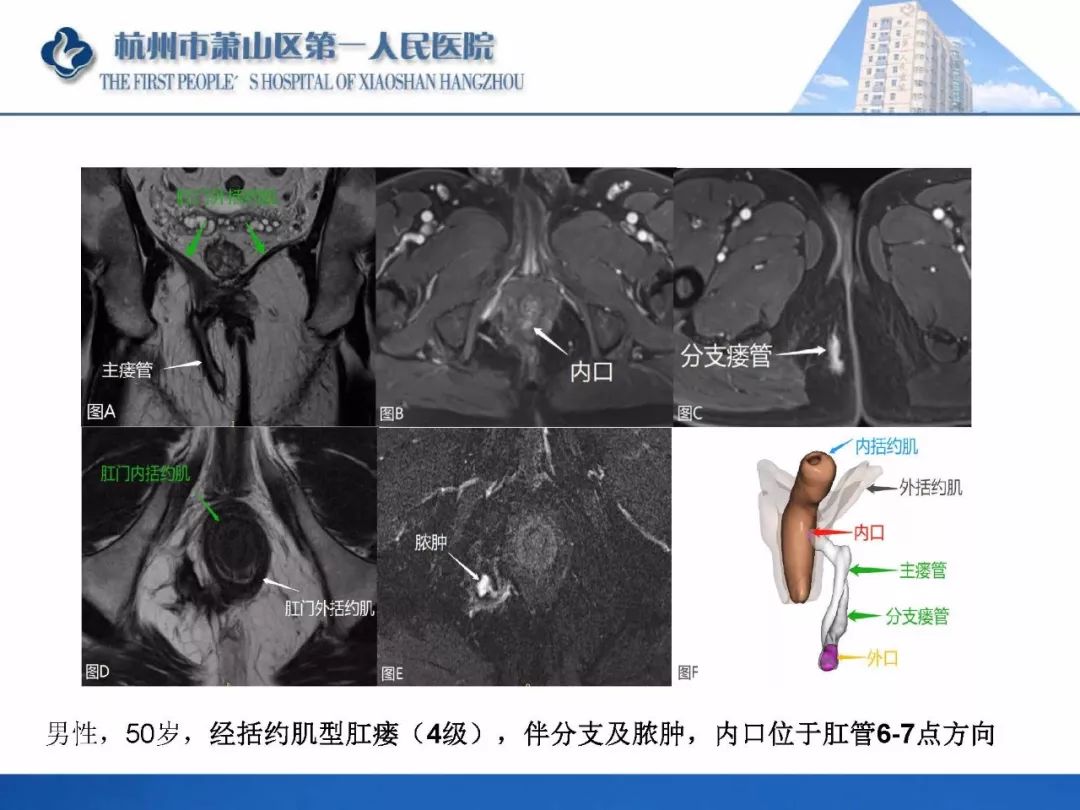 肛提肌mri图片