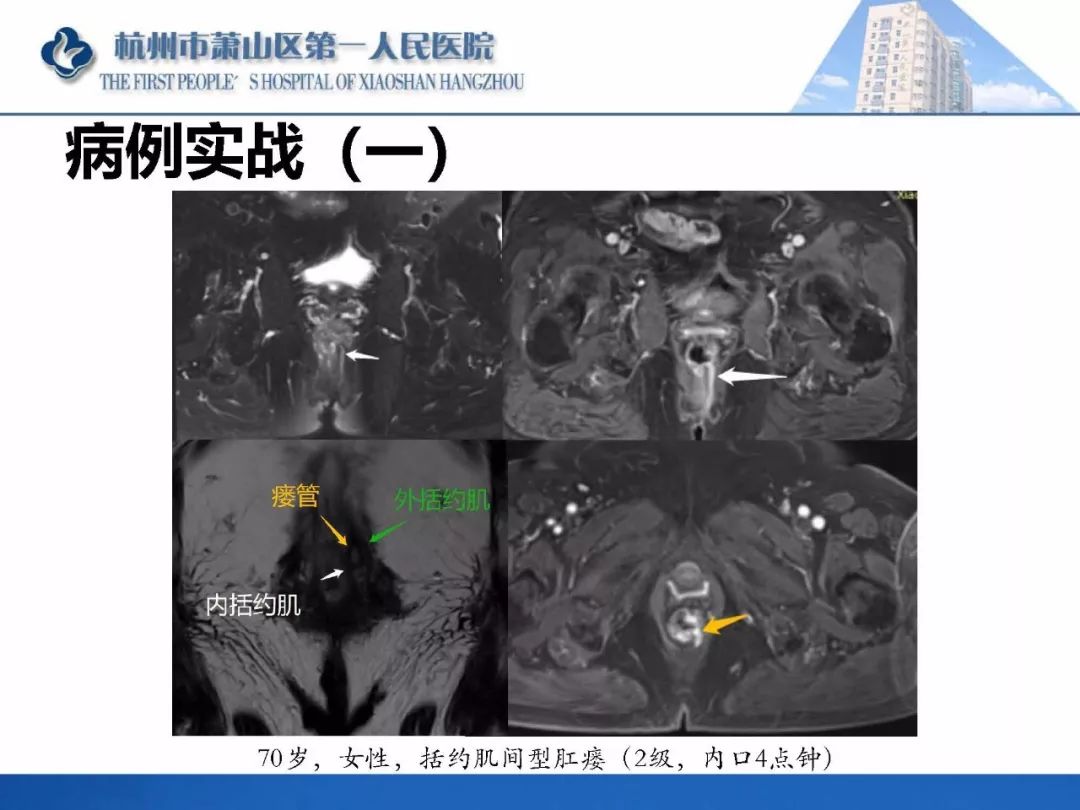 肛提肌mri图片