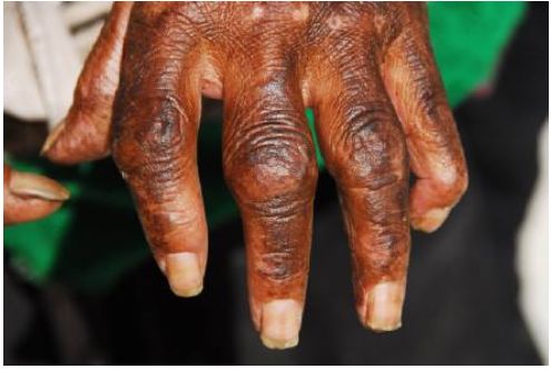 2%的克山病病区县达到控制标准.