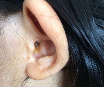 孩子3岁"急性中耳炎",儿童预防中耳炎的5大注意事项需关注