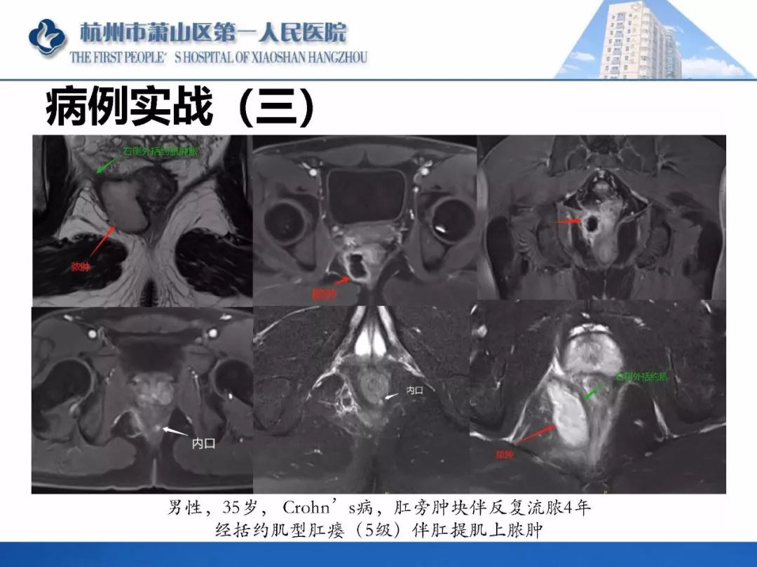 清晰版肛瘘的mri诊断
