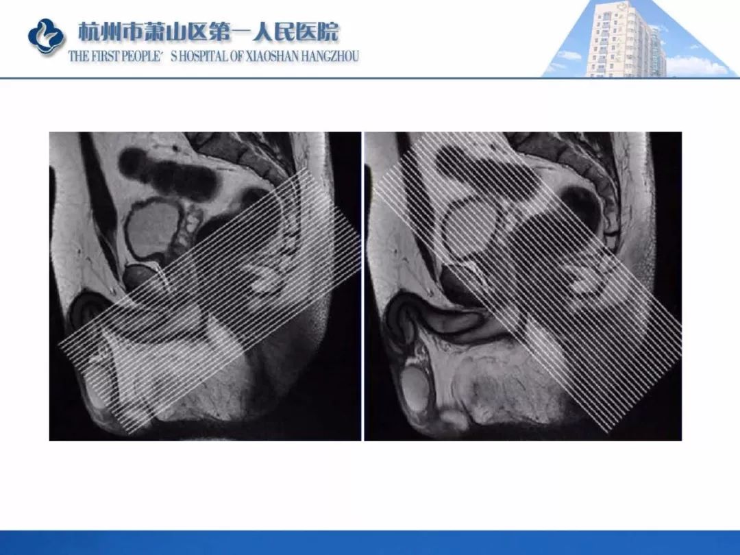 肛提肌mri图片