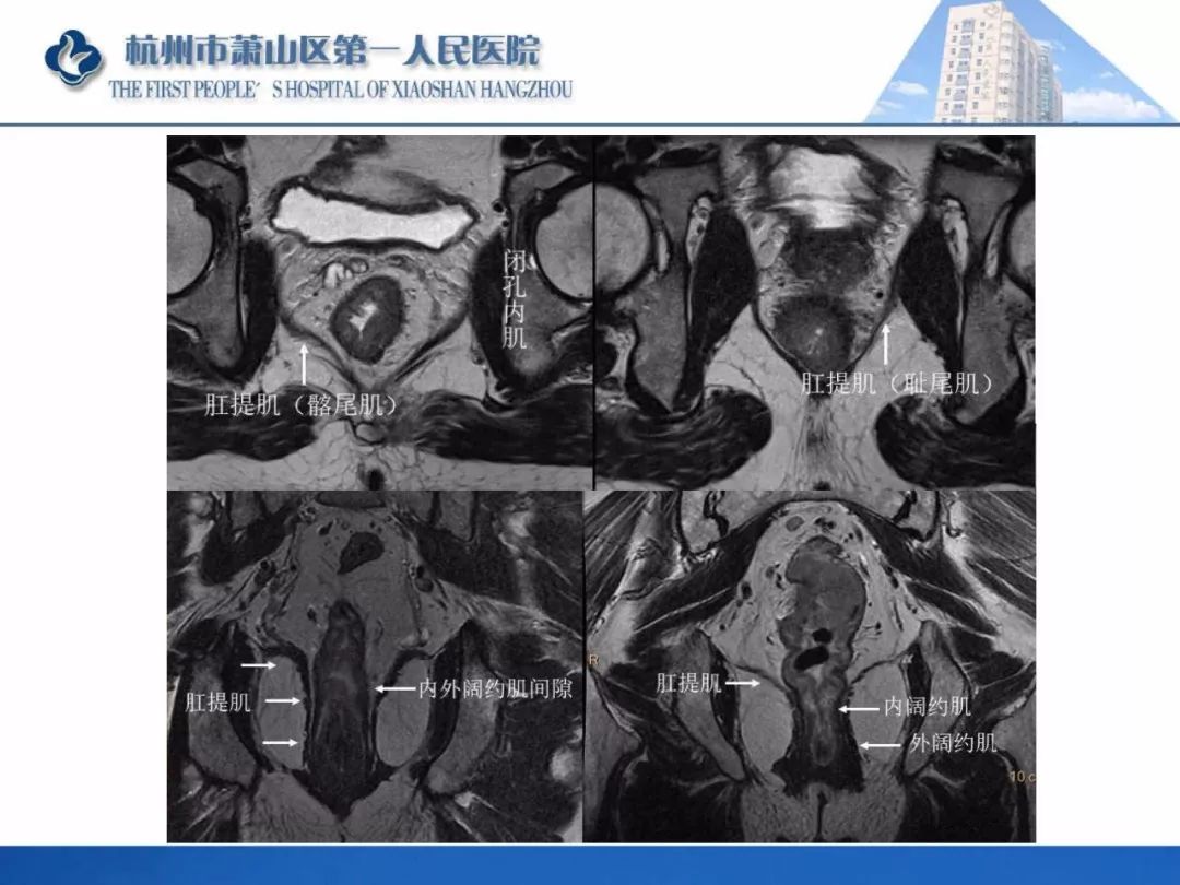 肛提肌mri图片