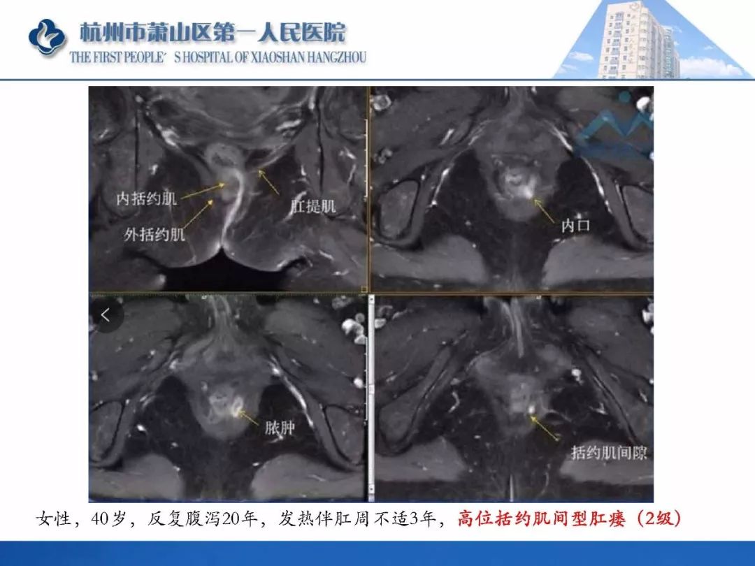 清晰版肛瘘的mri诊断