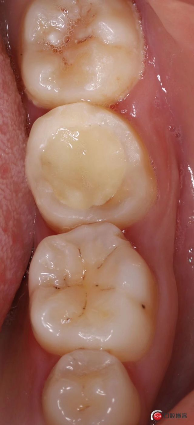 后牙rct树脂修复