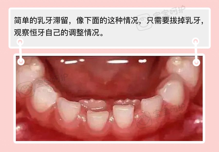 双排牙的原因图片