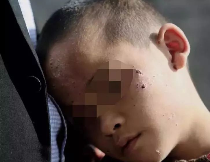 心疼云南一9岁孤独症男孩每天疯狂自残脸部手部有大面积伤痕
