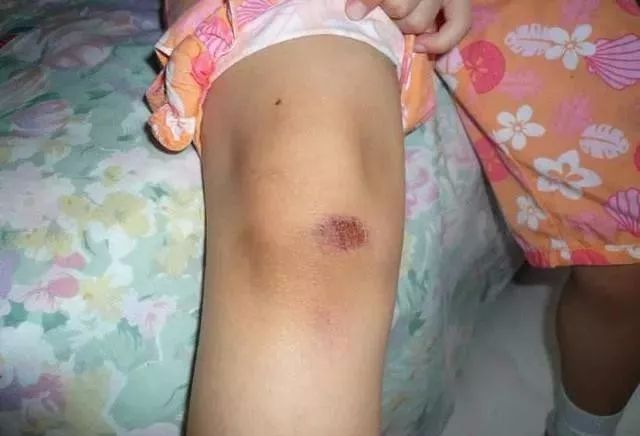 花椒鸡蛋清太厉害了腿不痛了关节积液都溜走了